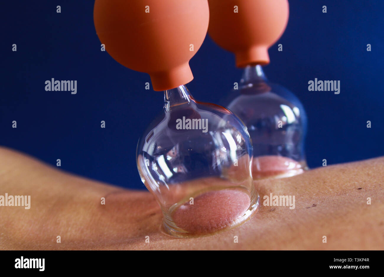 Cupping therapy as a form of alternative chinese medicine Stock Photo