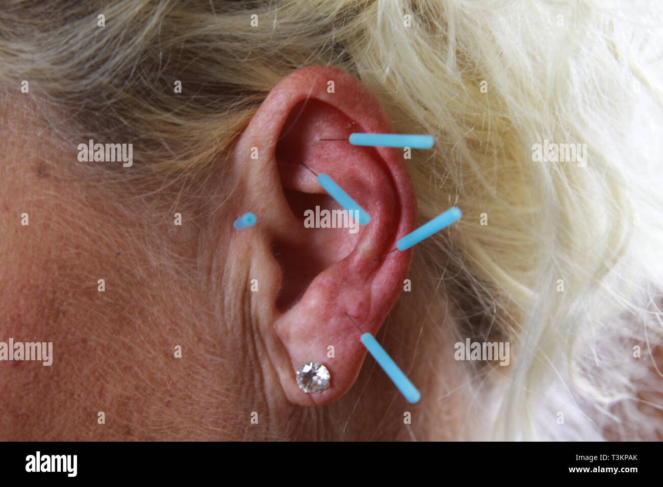 Close up of human female ear with blue needles Ear acupuncture as a