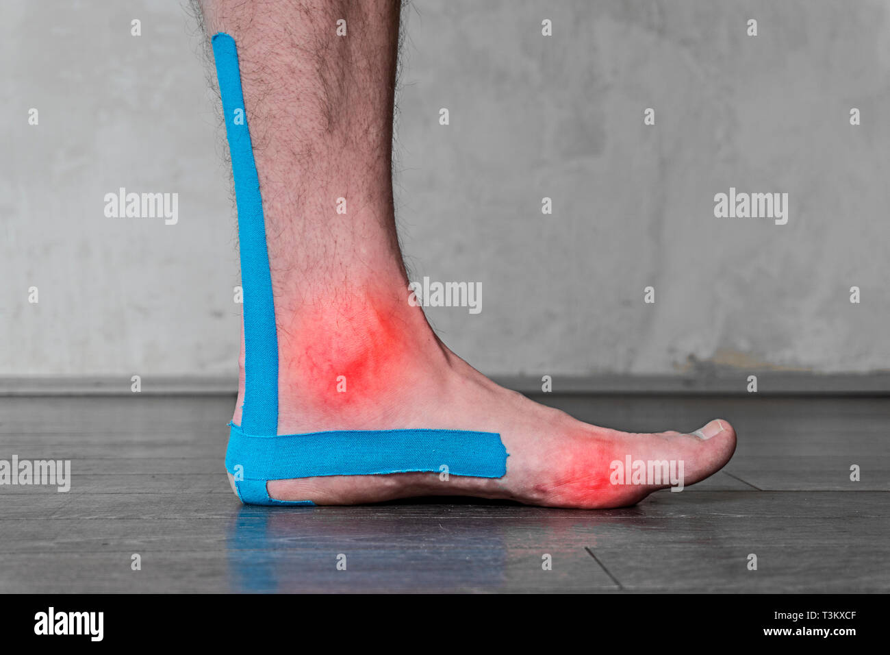 Male leg with ankle sprain, taped with specialized therapeutic cotton tape, sports injury, tendinitis, strain, fracture. Stock Photo