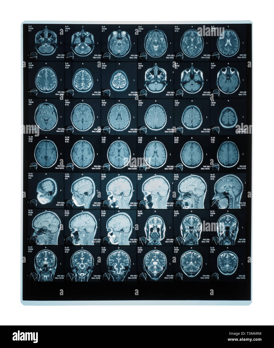 Real brain MRI slide of a young woman. Patient's and clinics names cloned out Stock Photo