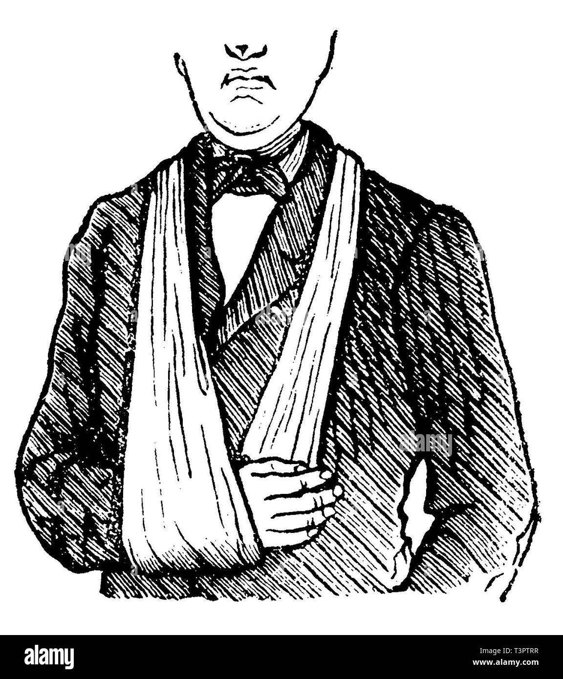 Arm sling, anonym  1887 Stock Photo