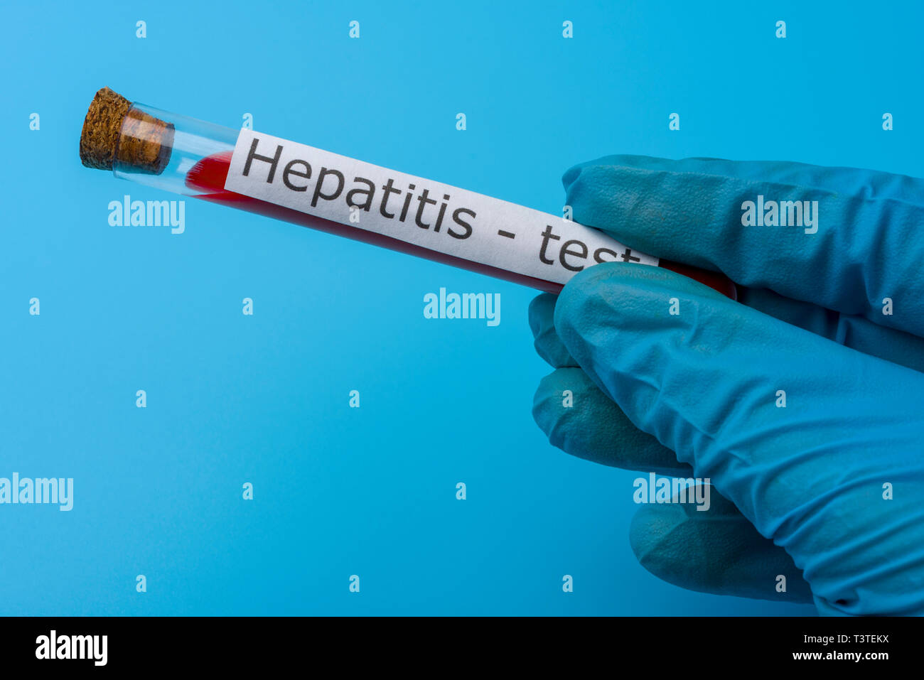 Hepatitis test, Blood in the test Tube. The concept of Medicine and