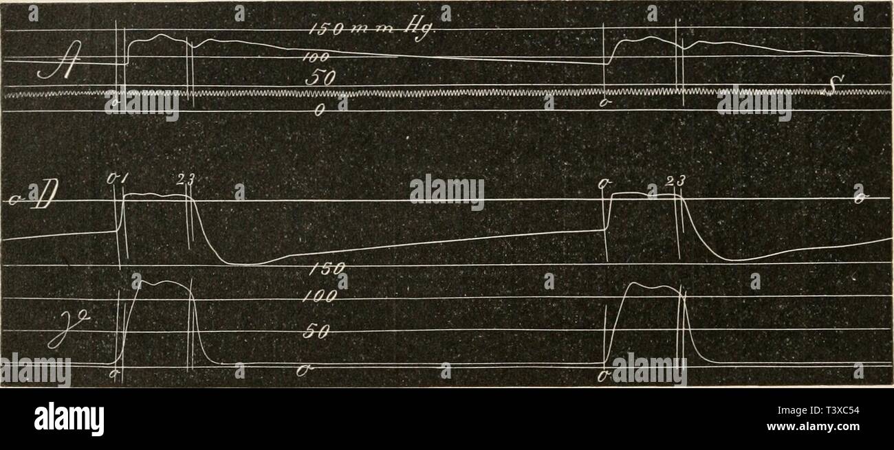 Archive image from page 161 of Die Physiologie des Kreislaufes (1921). Die Physiologie des Kreislaufes  diephysiologiede01tige Year: 1921  150 Die mechanischen Leistungen des Herzens. erscheint er in der Regel um so früher, je steiler die Drucksteigerung in der Kammer am Ende des primären Anstiegs erfolgt. Die Zeit von der Eröffnung der Semilunar- klappen bis zum Gipfel der Anfangsschwingung beträgt nach C. Tigerstedt beim Kaninchenherzen in der Kammer 0,005—0,010 und in der Aorta 0,009—0,014 Sek.i Die Anfangsschwingung kann einzeln sein, es kommt aber in der Regel vor, daß mehrere solche Schw Stock Photo