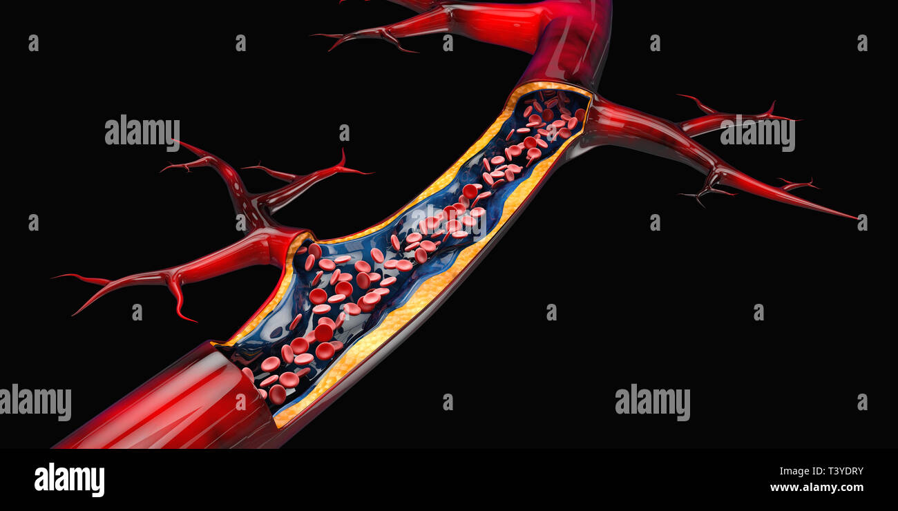 Aorta Plaque Build Up