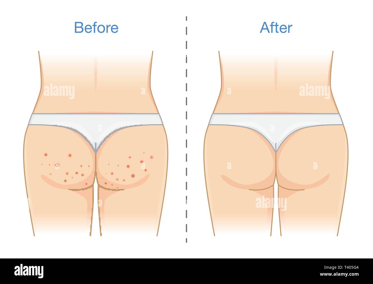 Buttocks with many pimples and after skin treatment. Stock Vector