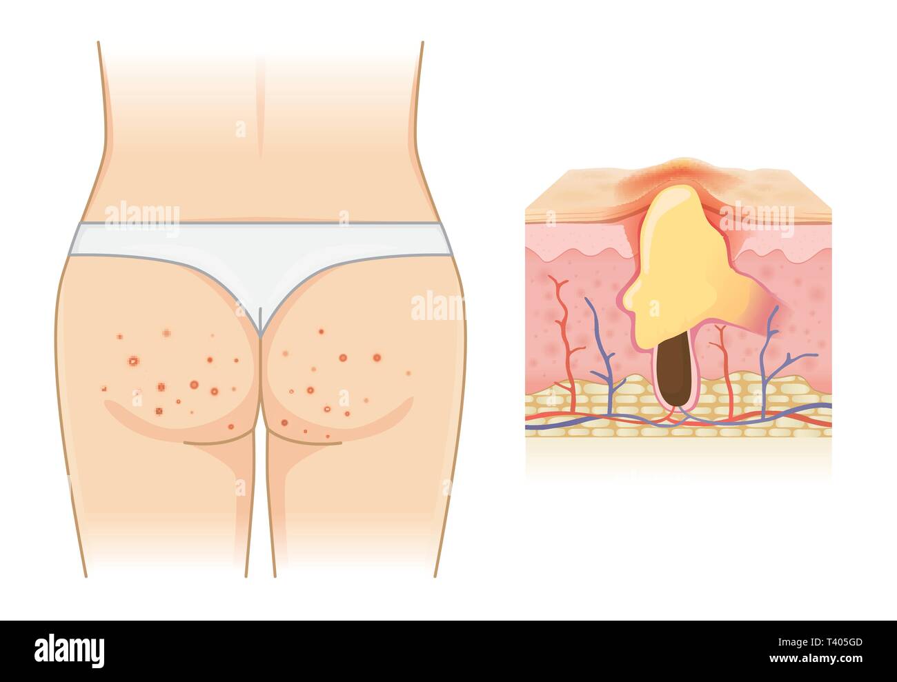 Pimples on buttocks and skin layer with acne isolated on white. Stock Vector