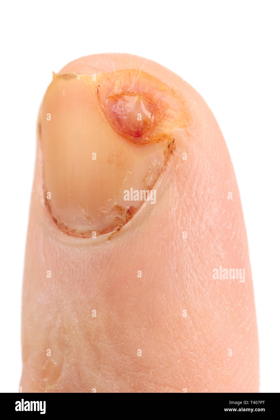 Blood wound finger nail hi-res stock photography and images - Alamy