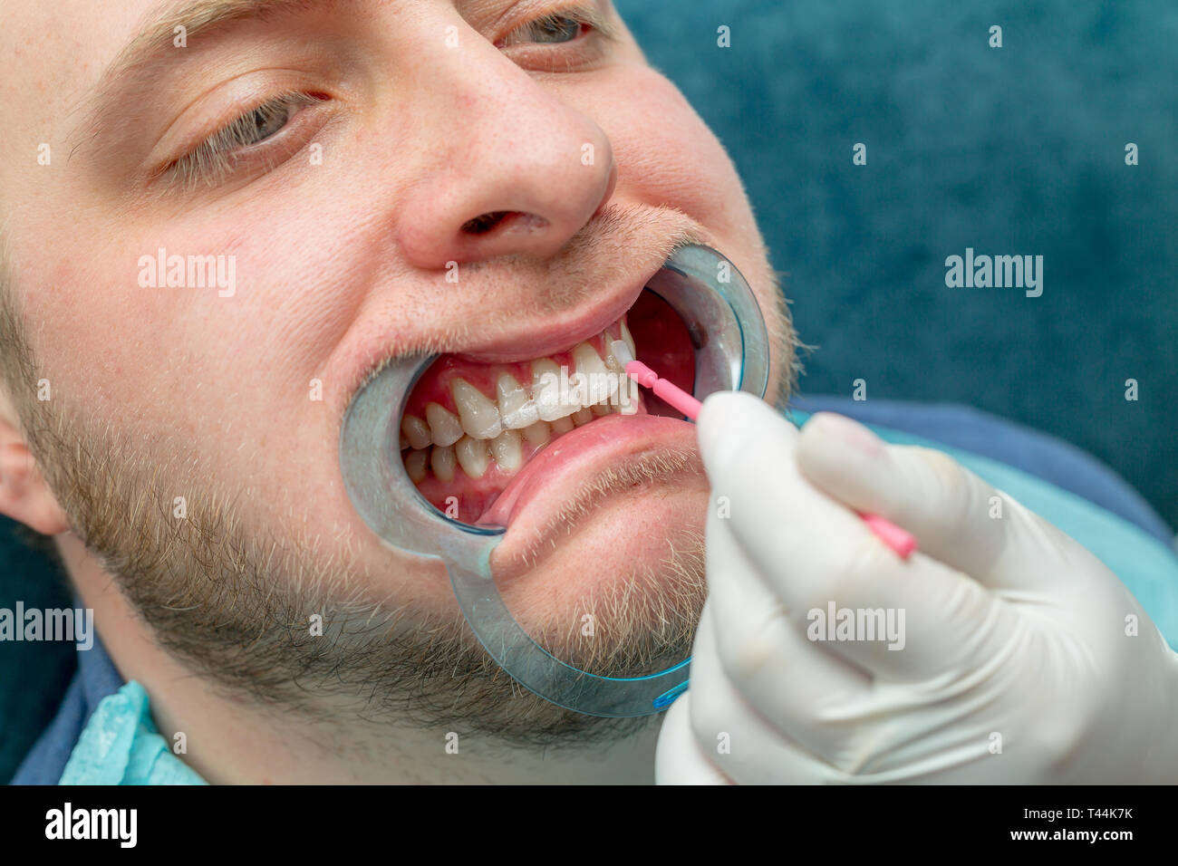 Teeth whitening procedure. Dental care concept Stock Photo Alamy