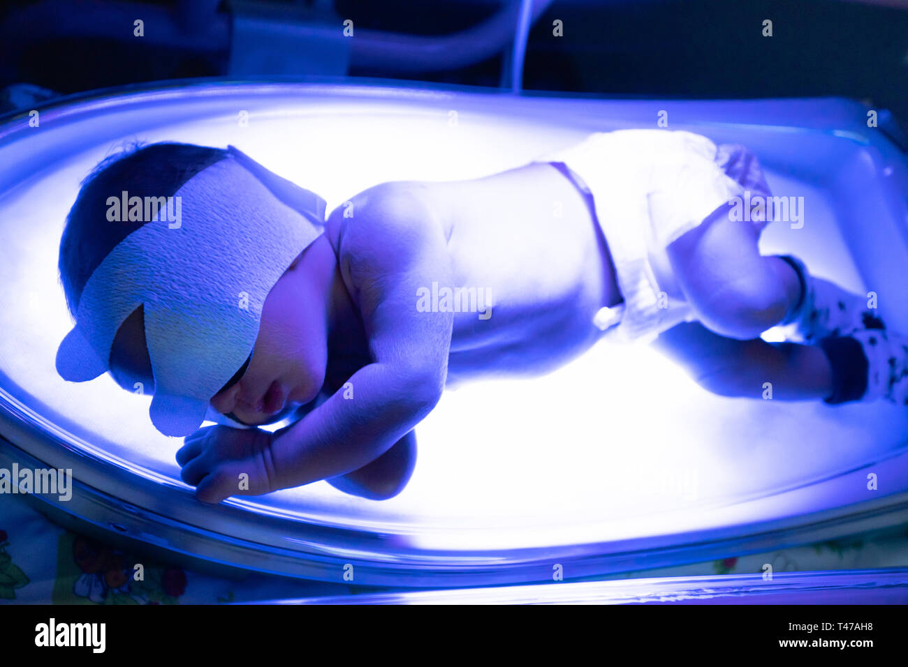 The baby lies under an ultraviolet lamp with jaundice Stock Photo