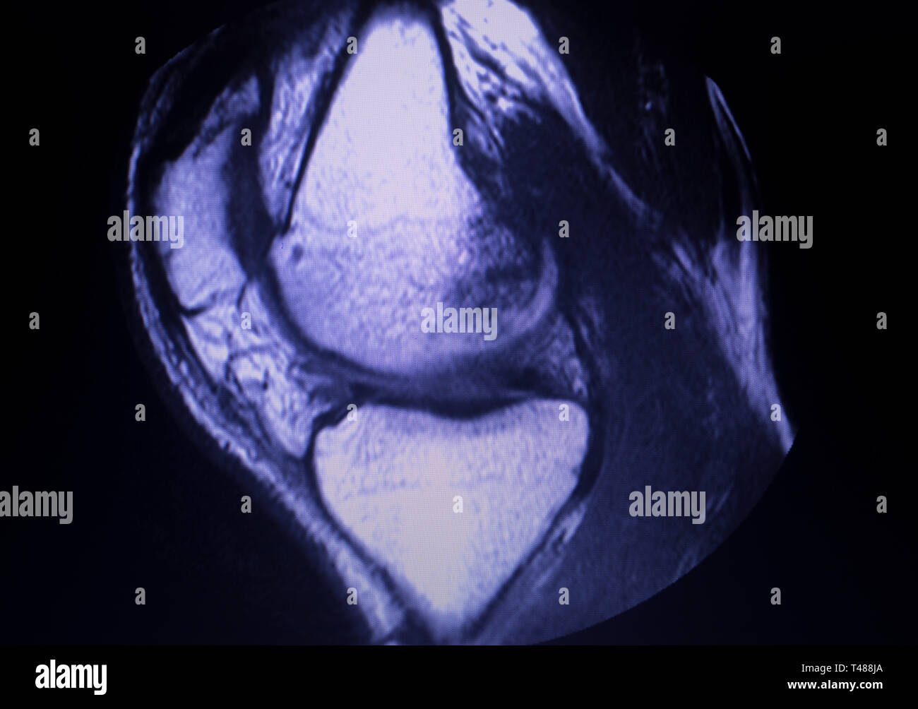 Magnetic resonance imaging MRI knee posterior horn medial meniscus tear ...