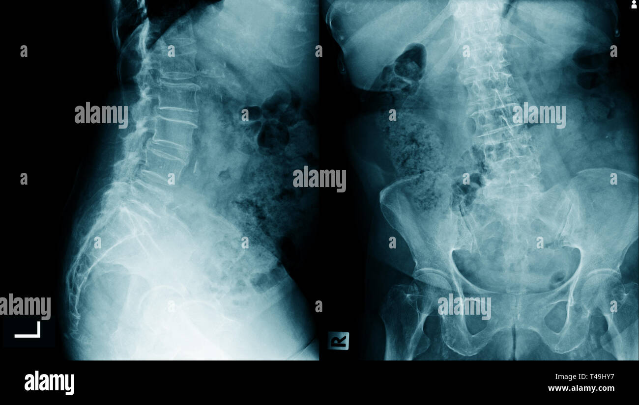 Lumbar Spondylosis X Ray