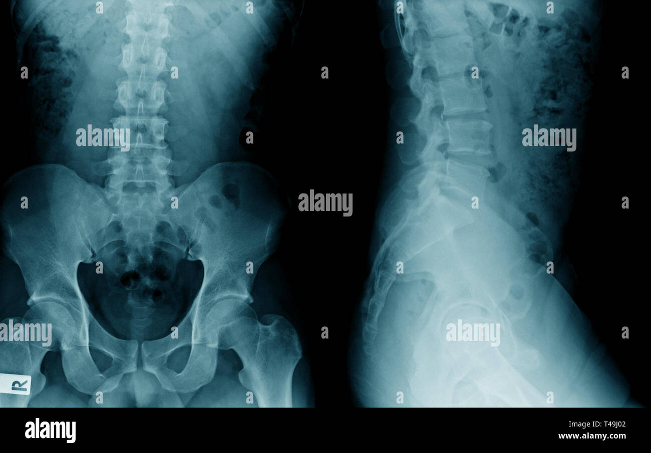 lumbar spondylosis xray image AP and lateral view Stock Photo Alamy