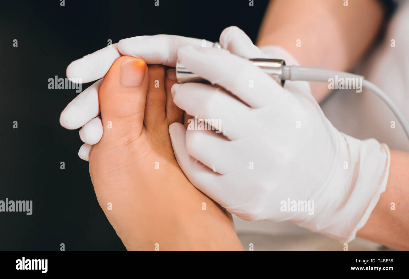 laser treatment on toenail, fungal infection on the toenails Stock Photo