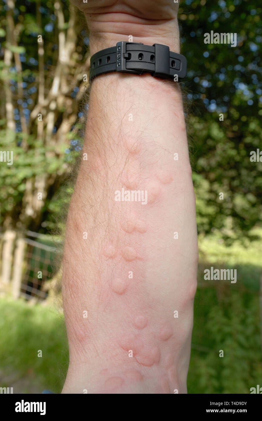 Biting Midges Bites Pictures