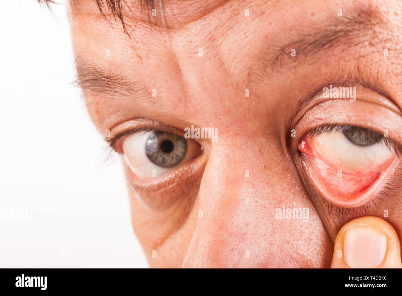 A man pulls his lower eyelid with his finger down Stock Photo Alamy