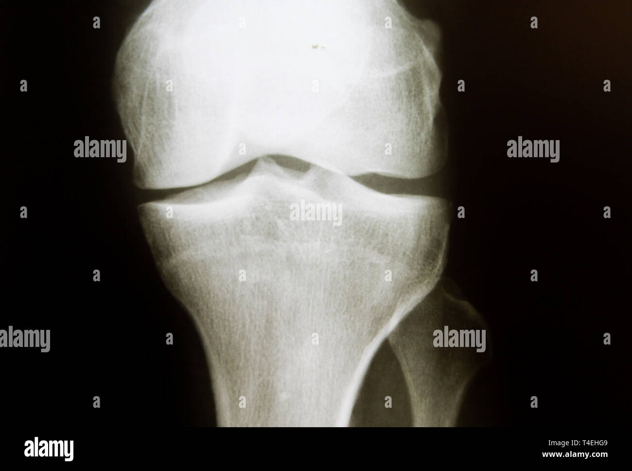 Normal knee x ray hires stock photography and images Alamy