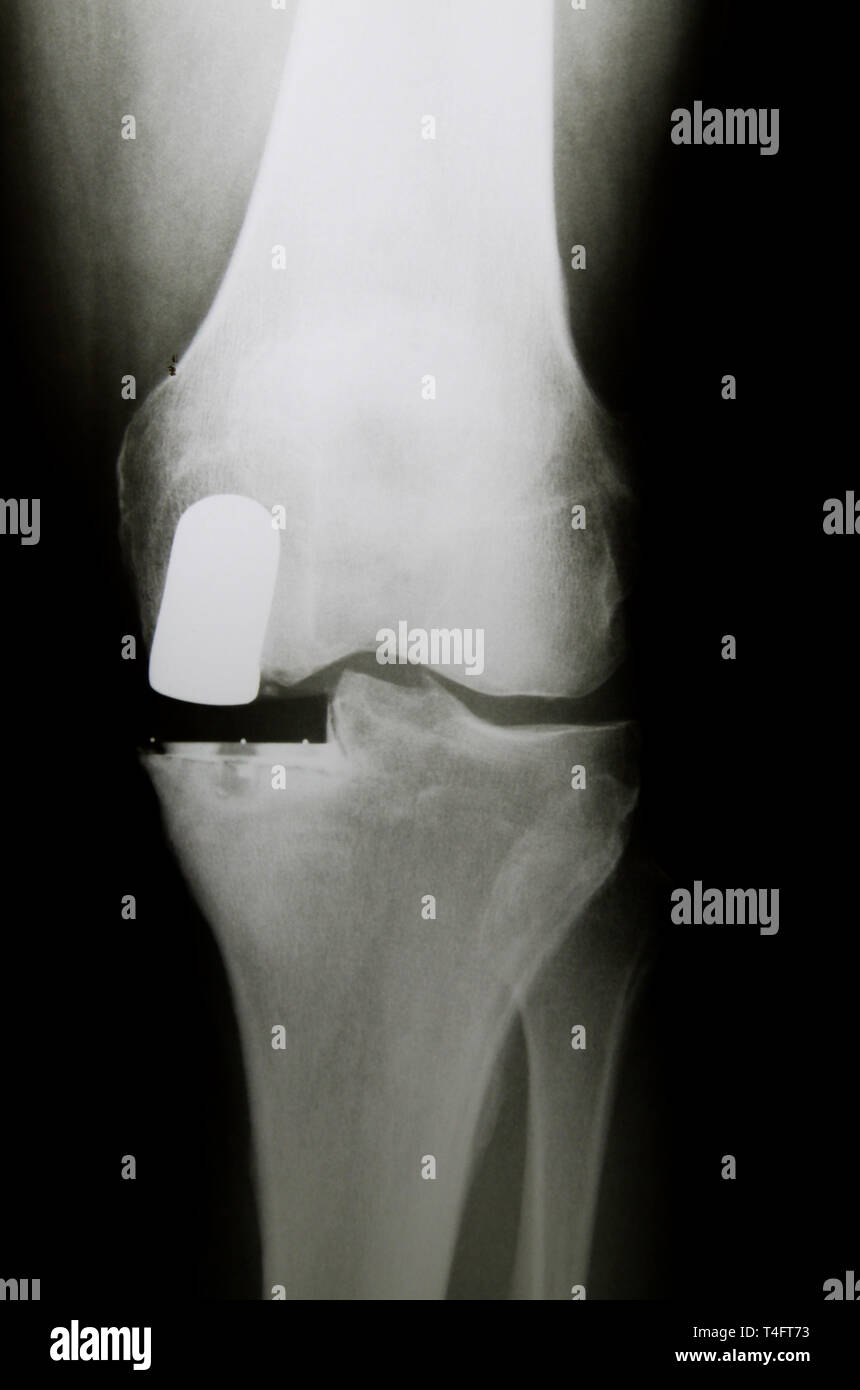 X-Ray image of knee with medial artificial partial prosthesis (Endoprosthesis) in case of arthrosis (joint degeneration) Stock Photo