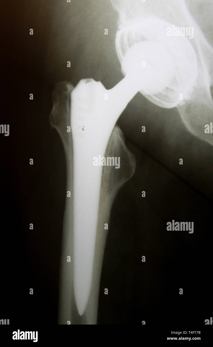 X-Ray image of hip with implanted artificial joint replacement (Endoprosthesis) in case of coxarthrosis (joint degeneration) Stock Photo