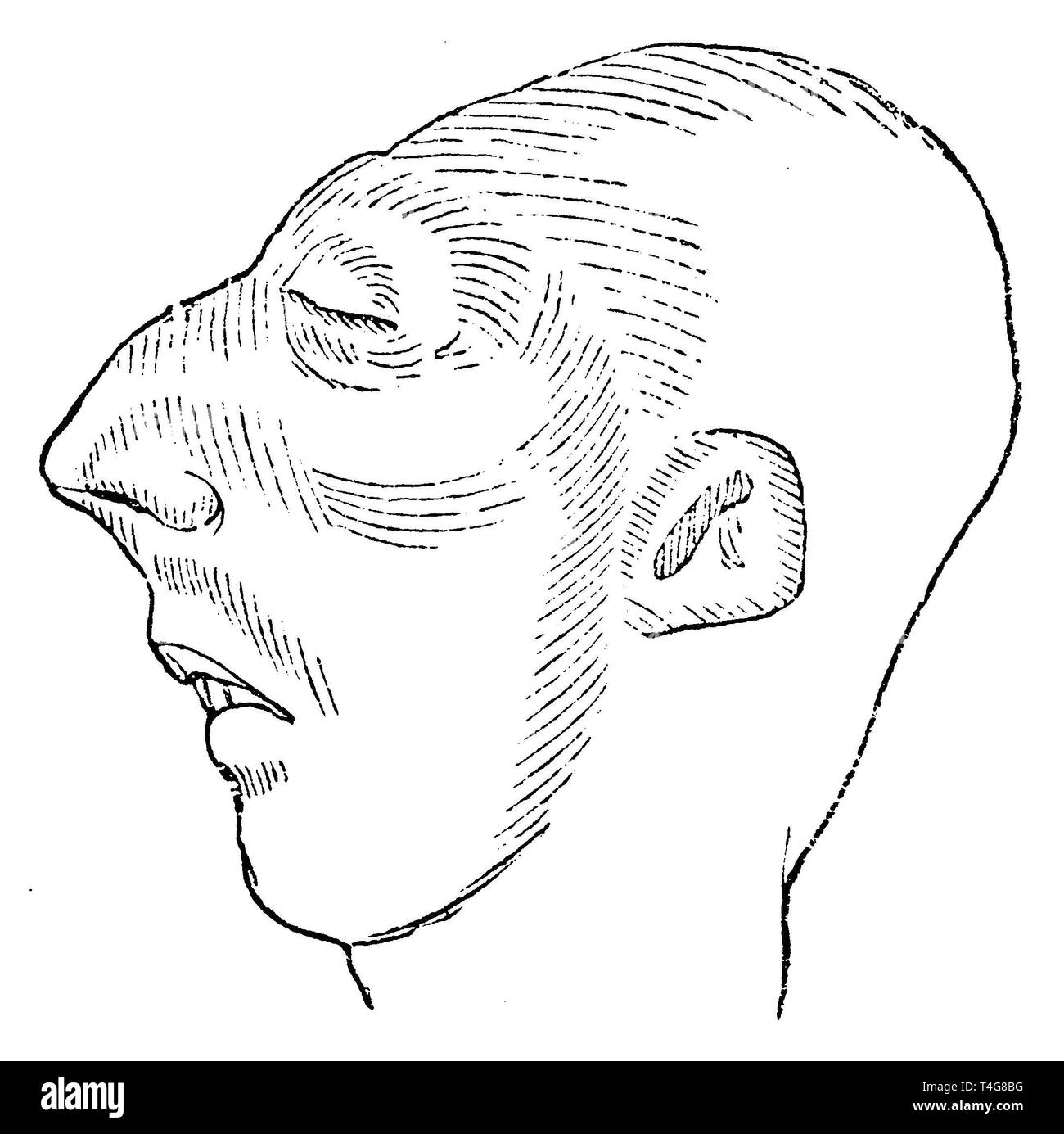 Human: Head of a cretin, anonym  1887 Stock Photo