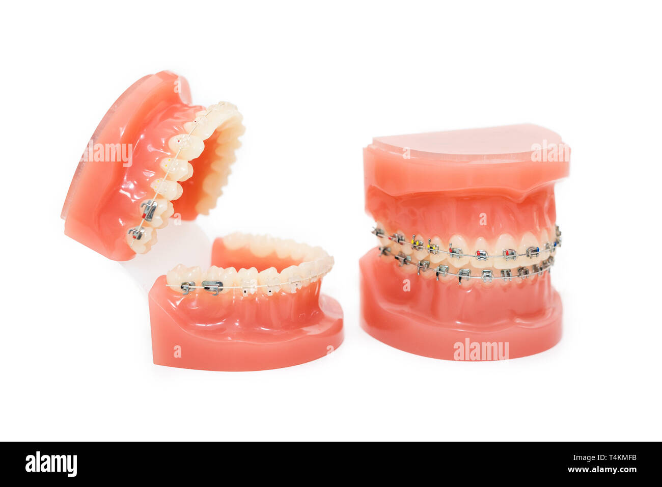 Orthodontic model and dentist tool - demonstration teeth model of varities of orthodontic bracket or brace. Metal and ceramic braces on teeth on an Stock Photo