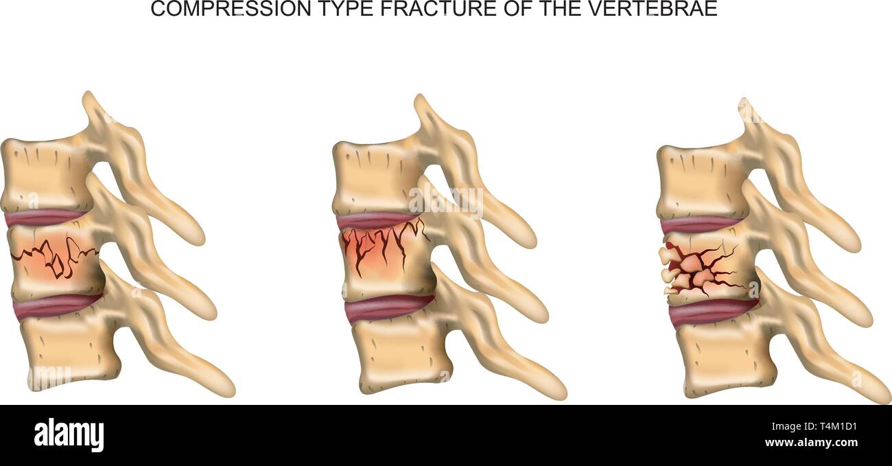 vector illustration of a compression type fracture of the spine Stock Vector