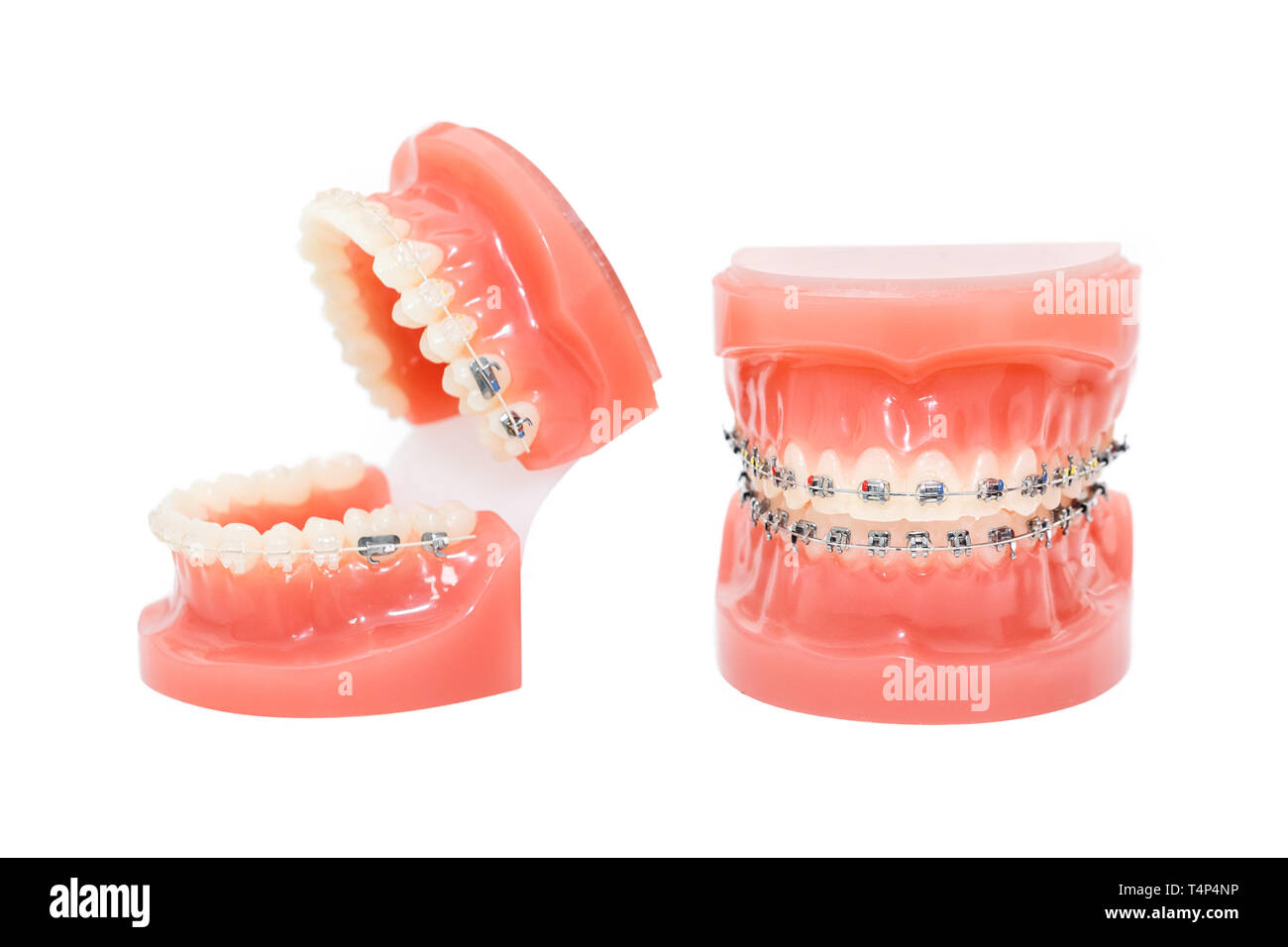 Orthodontic model and dentist tool - demonstration teeth model of varities of orthodontic bracket or brace. Metal and ceramic braces on teeth on an ar Stock Photo