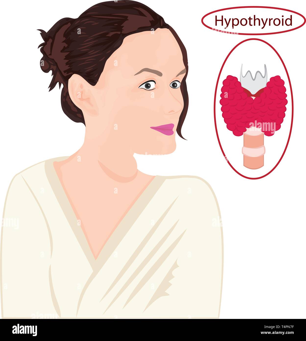 Goiter. Enlarged Thyroid. Endocrine disfunction vector illustration on a white background Stock Vector