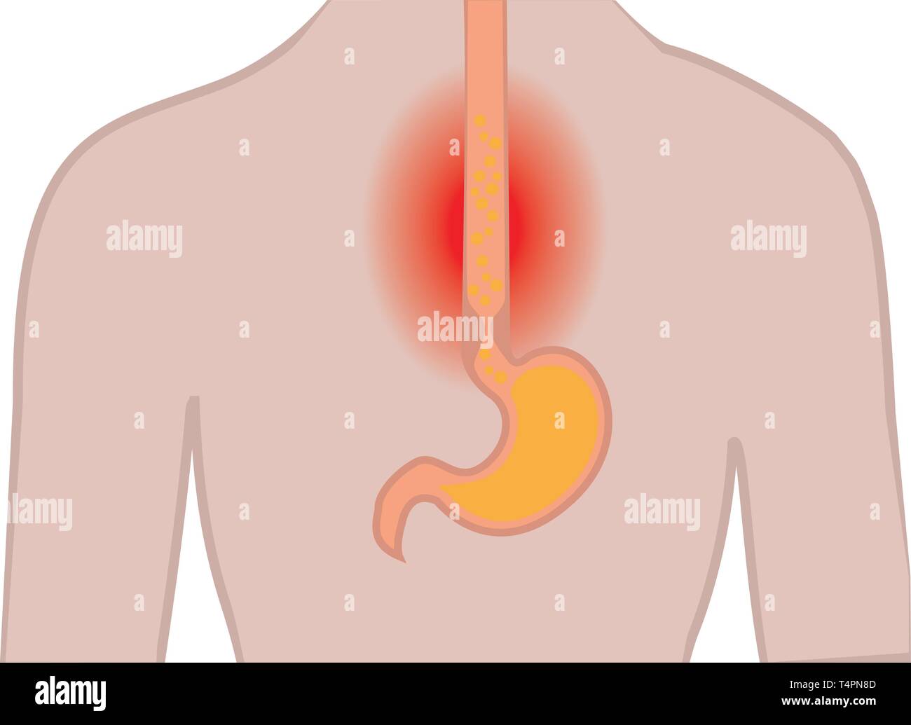 Gastroesophageal reflux desease. Heartburn Gerd stomach in a human body ...