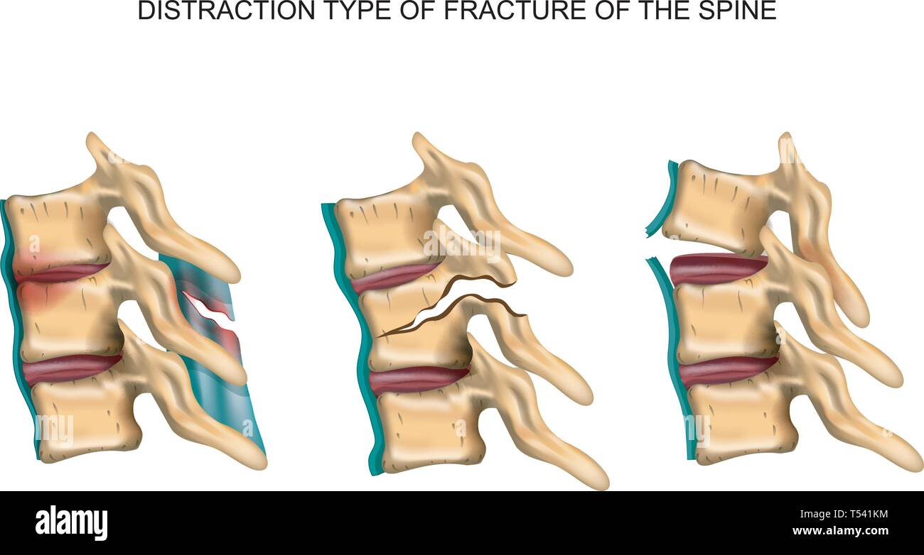 vector illustration of a distraction type of fracture of the spine Stock Vector