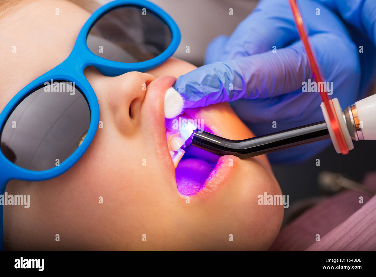 Ultraviolet Light Cure Fillings