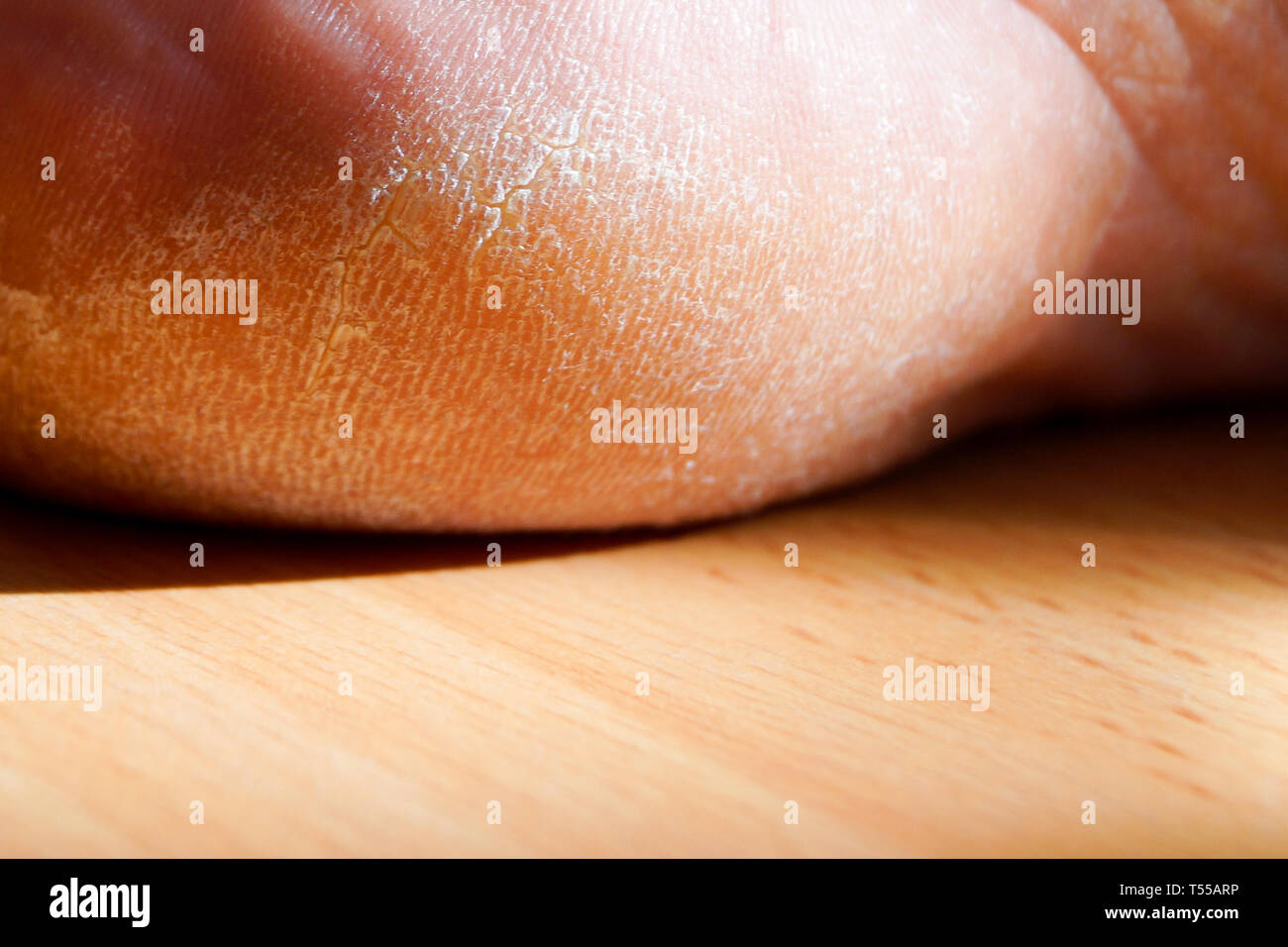 Callus heel hires stock photography and images Alamy