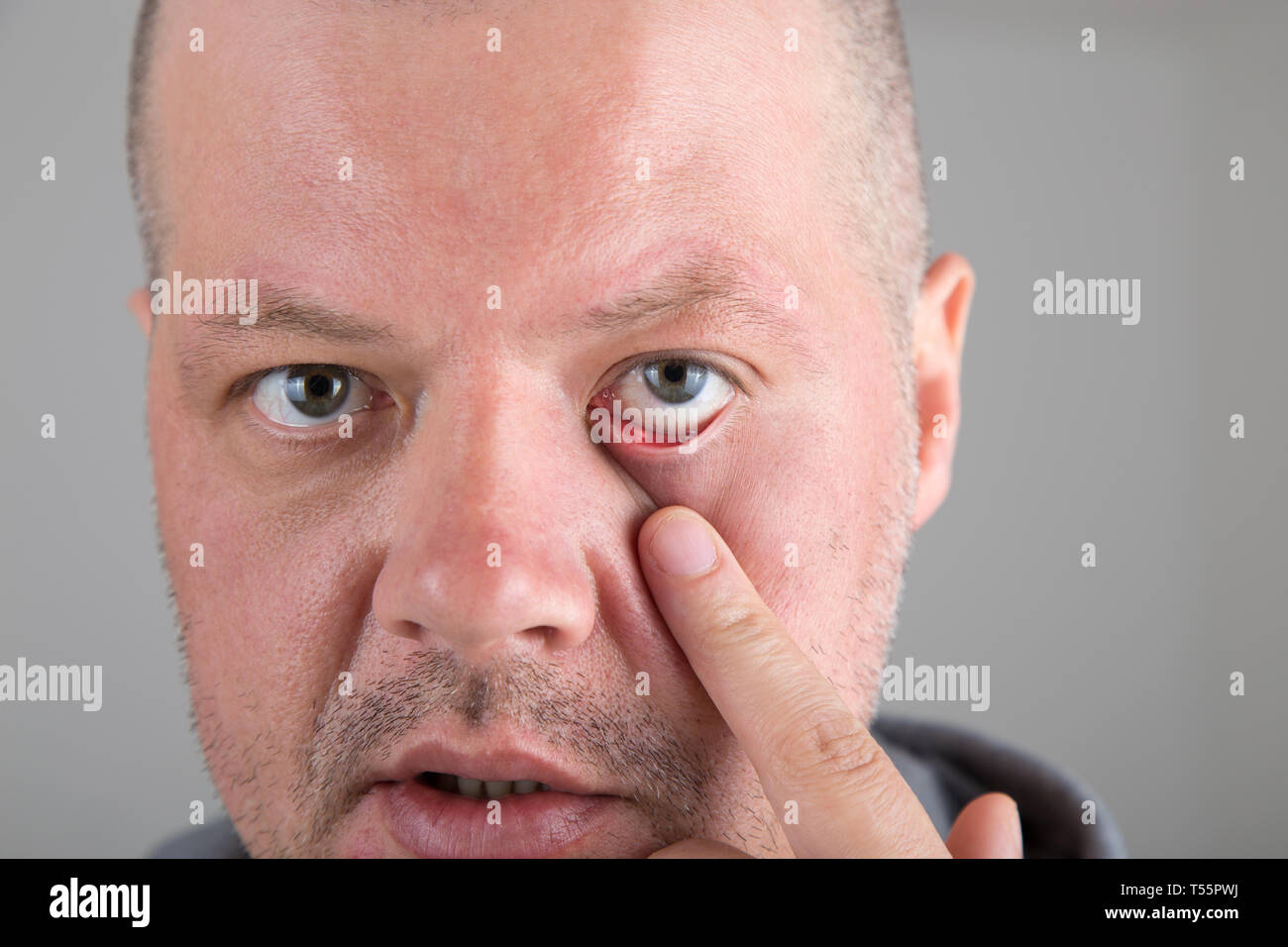 Male patient with  stye in the eye at the lower eyelid. Hordeolum or Chalazion Stock Photo