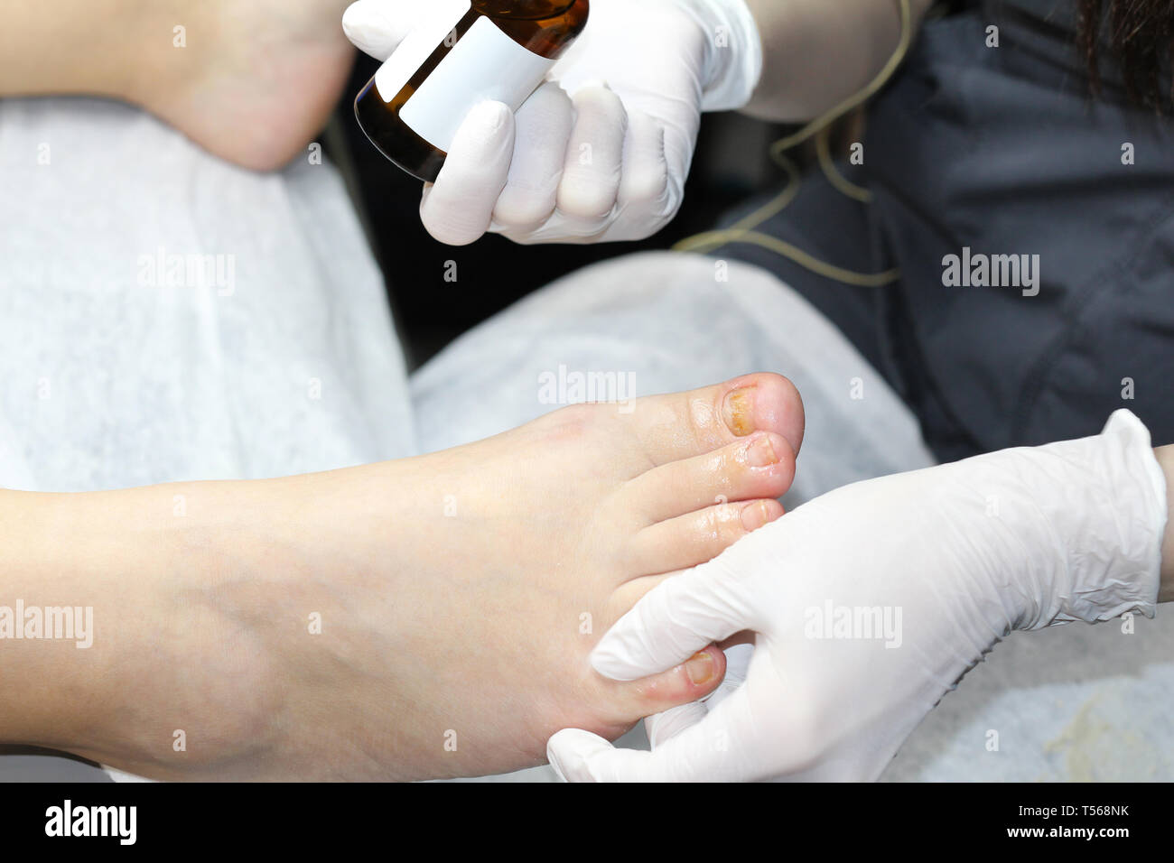Toenails after removing gel polish. Ugly toenails. The cosmetologist restores the toenails. Toenail care. Stock Photo
