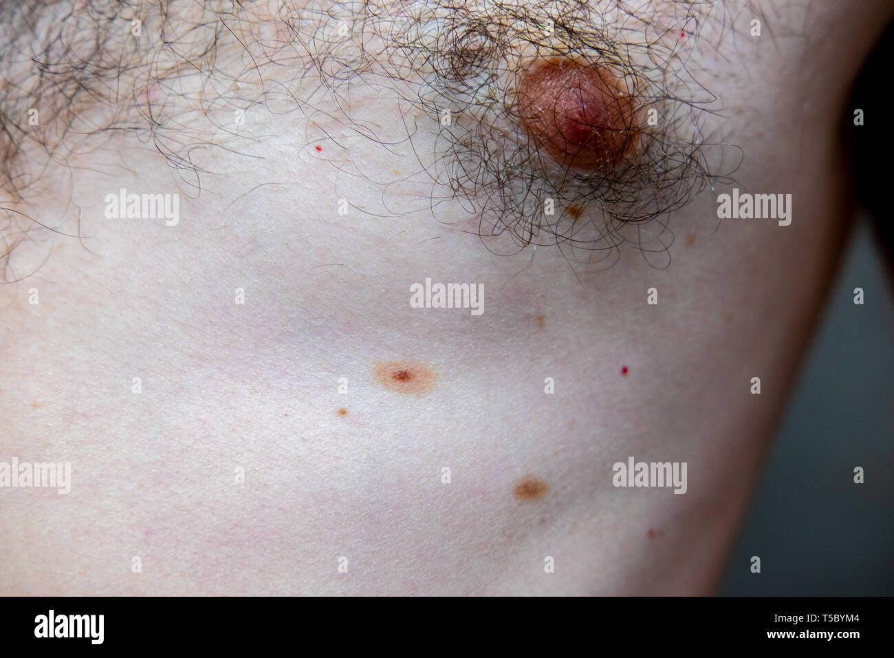 A melanocytic nevus also known as nevocytic , nevus-cell and commonly as a mole is a type of tumor that contains nevus cells. Stock Photo