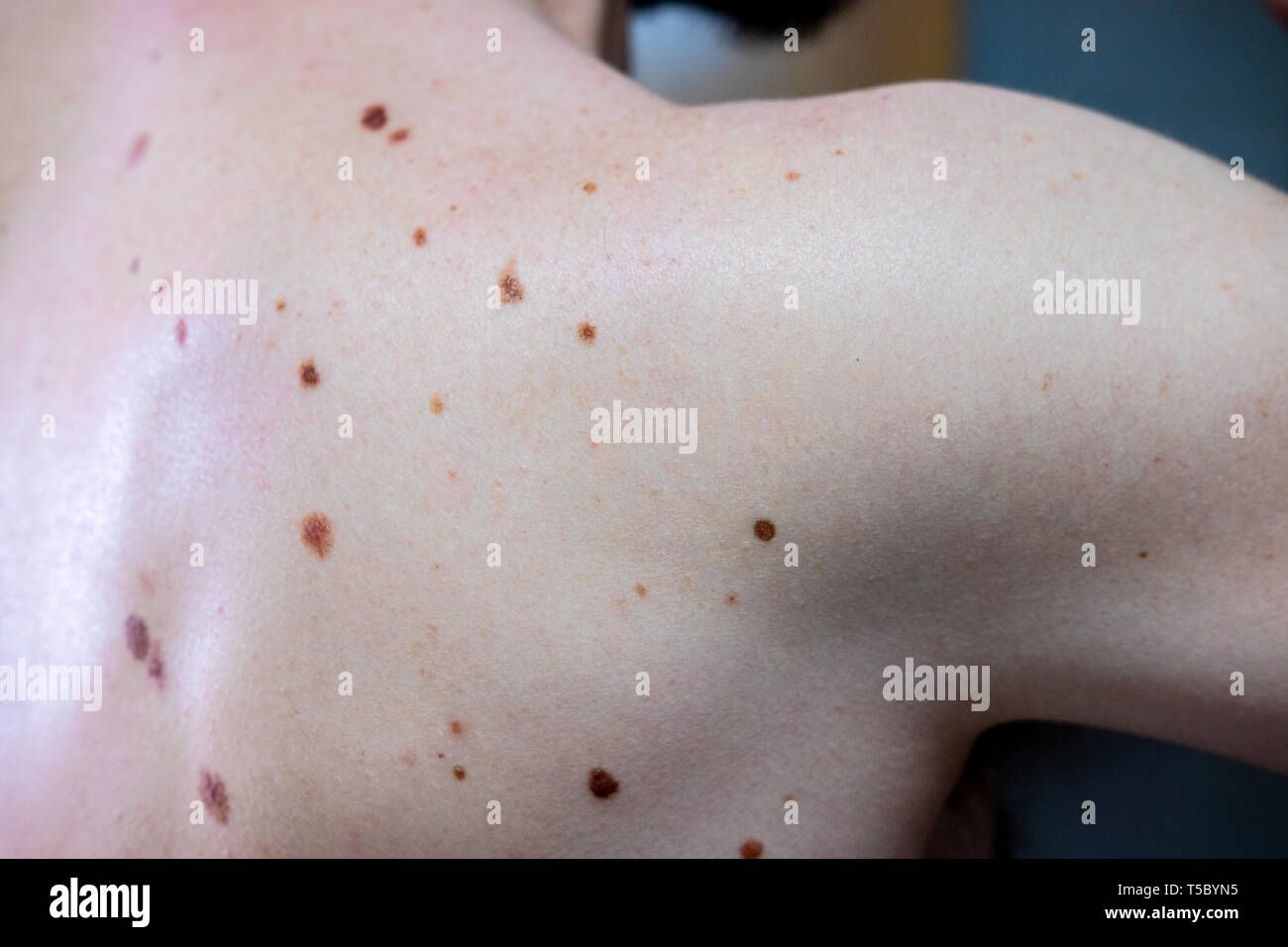 A melanocytic nevus also known as nevocytic , nevus-cell and commonly as a mole is a type of tumor that contains nevus cells. Stock Photo