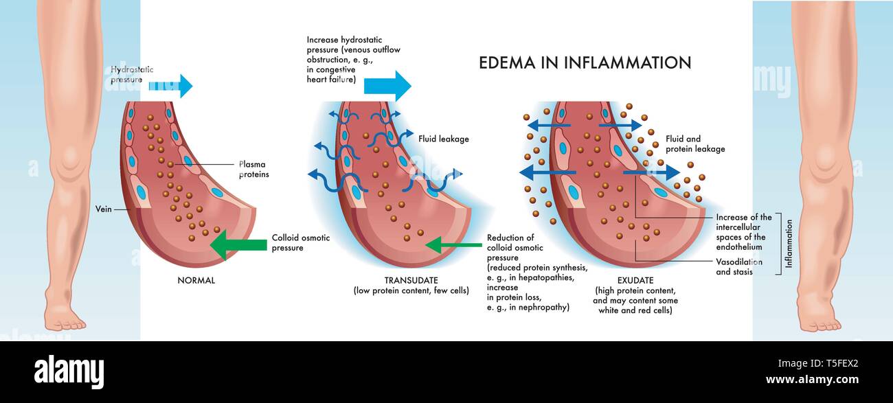Main stages of edema inflammation illustrated in medical diagram. Stock Vector