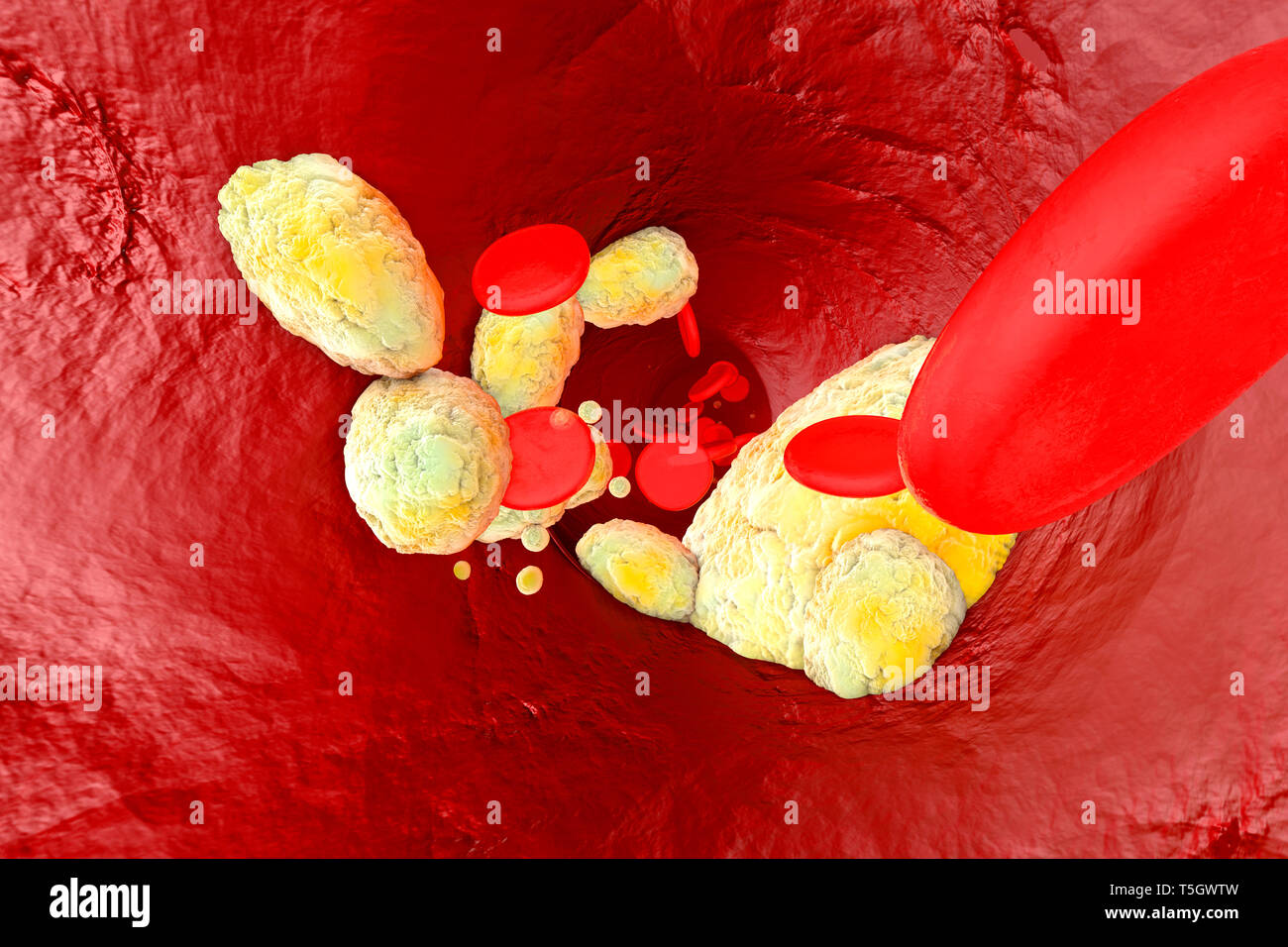 3D Rendered illustration, visualisation of fat clogging a artery and forming the sickness arteriosclerosis Stock Photo