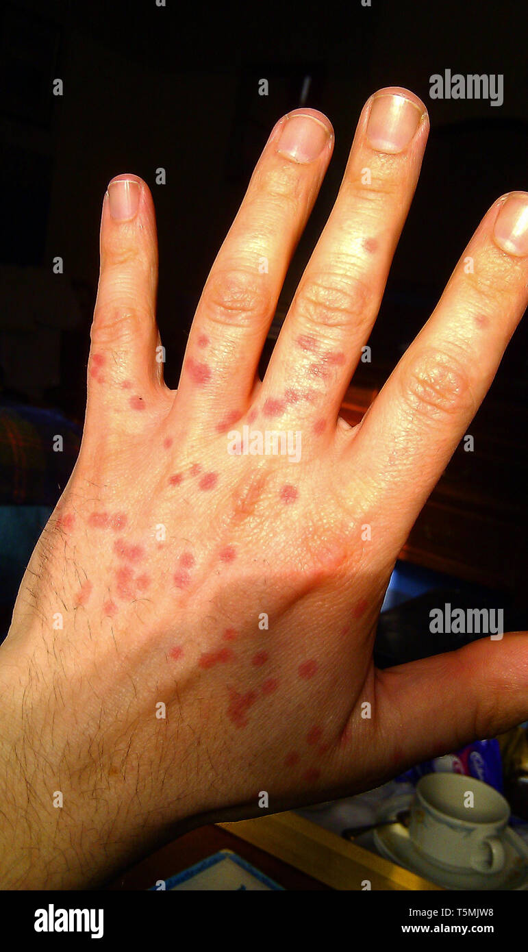 Scottish midge bite marks on hand Stock Photo