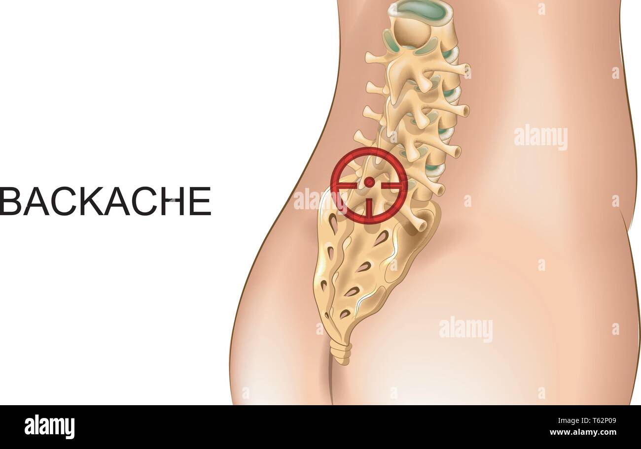 vector illustration of pain in the sacrum and lumbar vertebrae Stock Vector