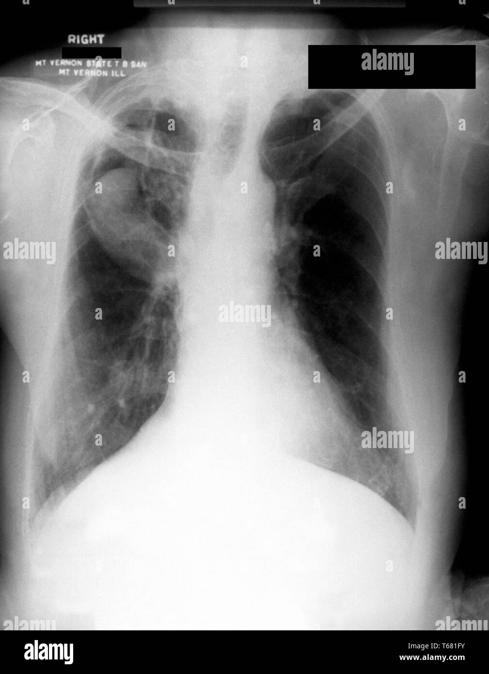 Fungal disease prevention Black and White Stock Photos & Images Alamy