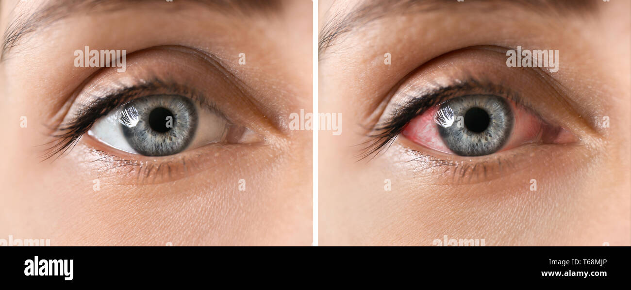 Young woman without and with eye redness, closeup Stock Photo