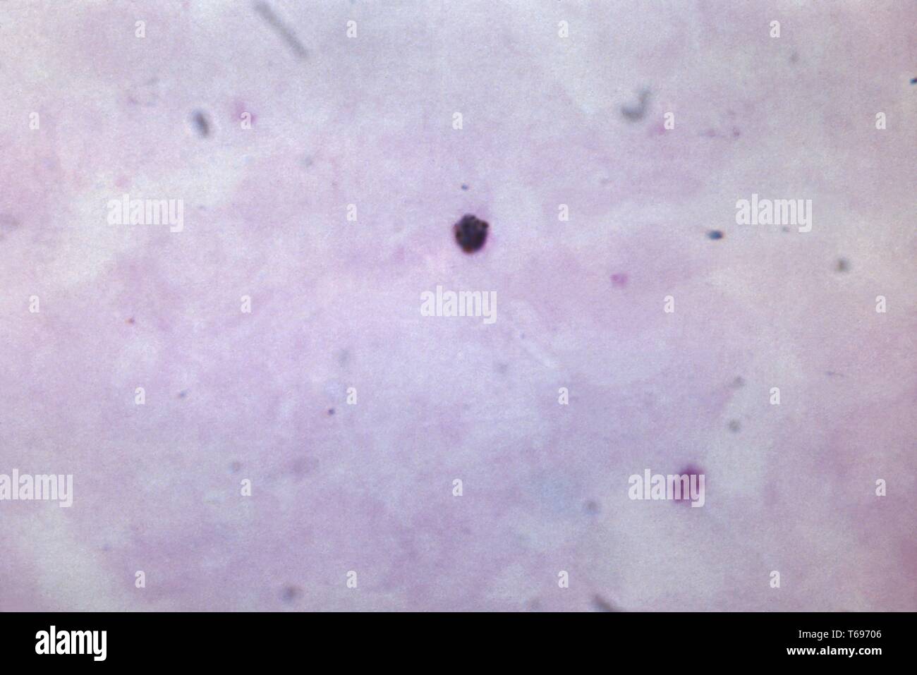 Thick Film Photomicrograph Of A Growing Plasmodium Malariae Trophozoite Image Courtesy