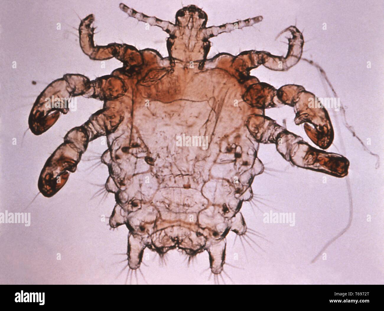Photomicrograph of the Phthirus pubis (crab louse), found in a human pubic hair, 1975. Image courtesy World Health Organization (WHO). () Stock Photo