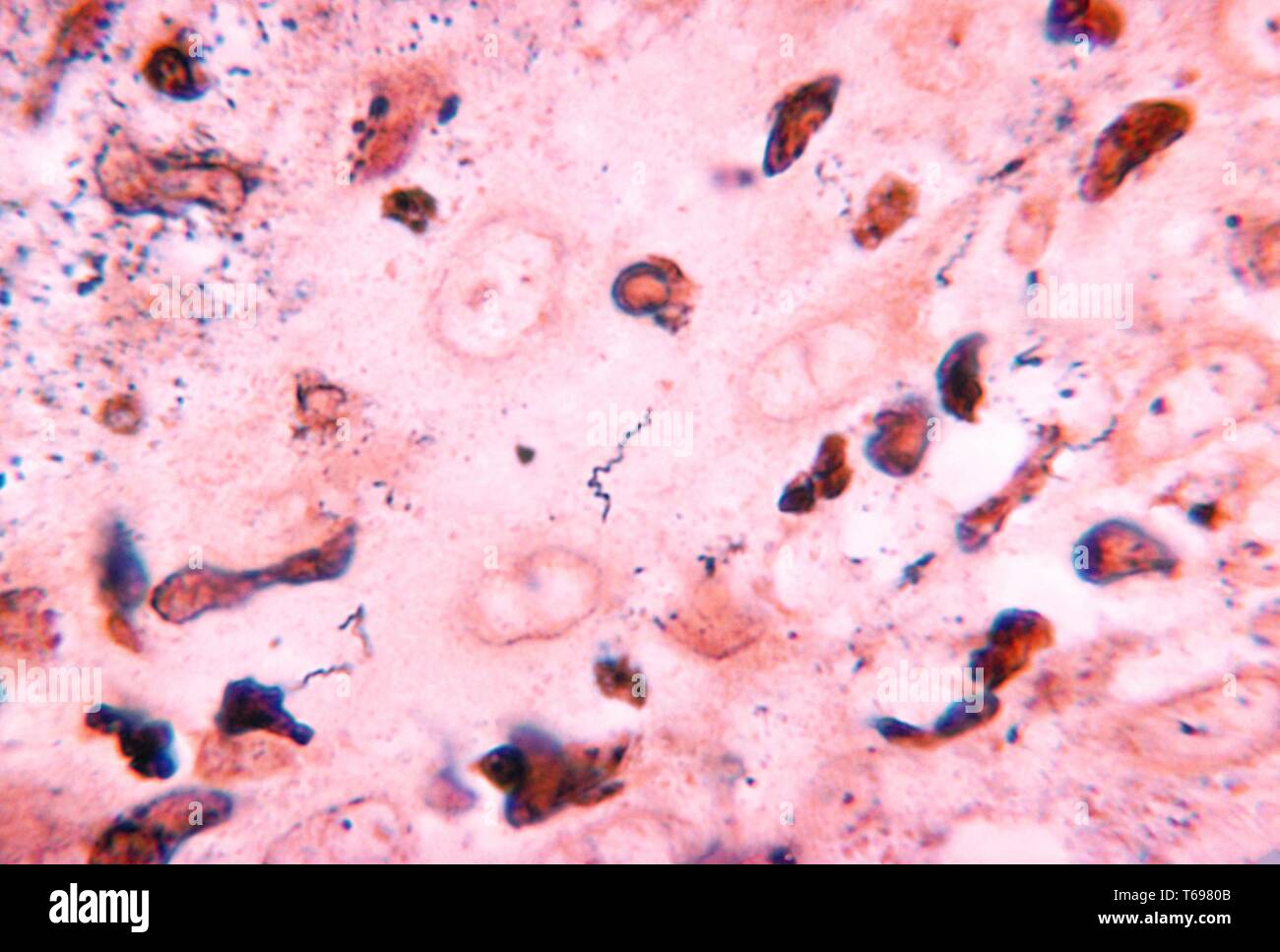 A photomicrograph revealing Treponema carateum bacteria obtained from a chimpanzee using Krajain's stain, 1970. Pinta is caused by Treponema carateum. This disease occurs only in tropical Central and South America. It is characterized by a painless papule (primary) followed 2 - 18 months later by secondary papules on the hands, feet and scalp. Image courtesy CDC. Stock Photo
