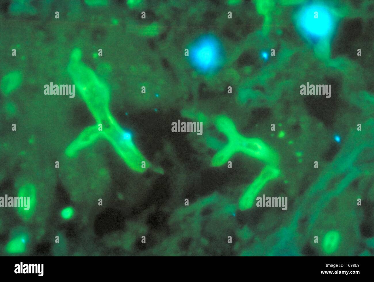 Fluorescent antibody stain photomicrograph of the histopathologic changes in zygomycosis caused