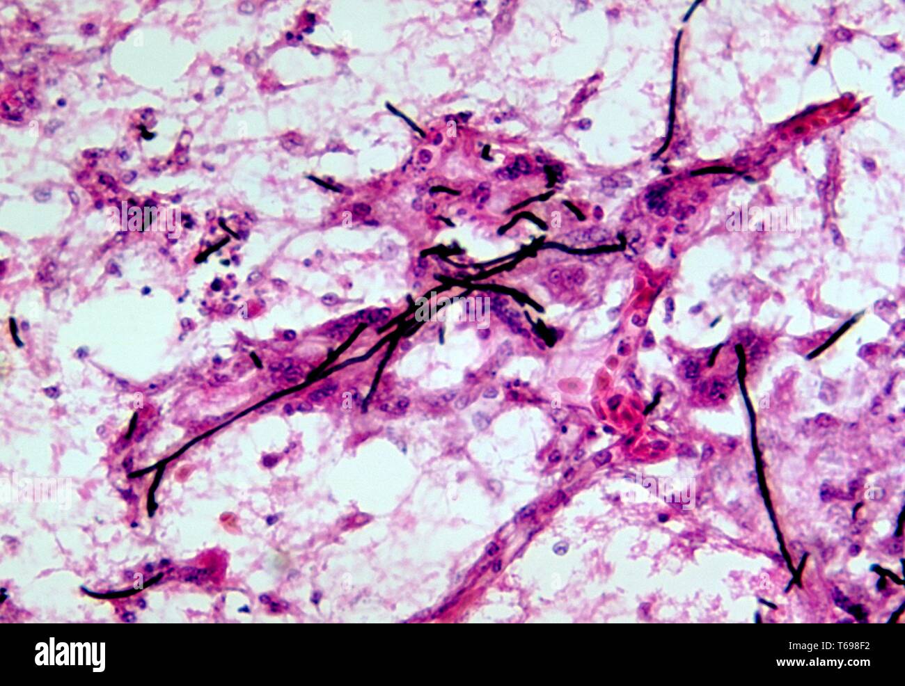 Photomicrograph of the phaeohyphomycosis associated histopathologic changes in 2 weeks old chick brain tissue caused by the Ochroconis gallopavum fungus, 1972. Image courtesy Centers for Disease Control and Prevention (CDC) / Dr Lucille K. Georg. () Stock Photo