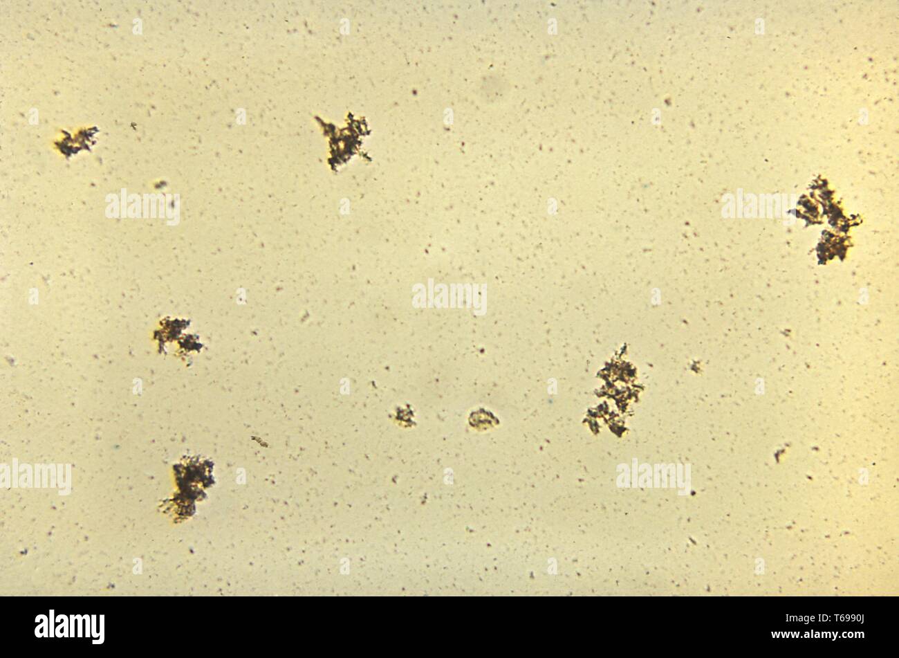 Unstained photomicrograph of the Venereal Disease Research Laboratory (VDRL) slide test for Syphilis, sexually transmitted disease caused by the bacterium Treponema pallidum, 1969. Image courtesy Centers for Disease Control and Prevention (CDC) / Renelle Woodall. () Stock Photo