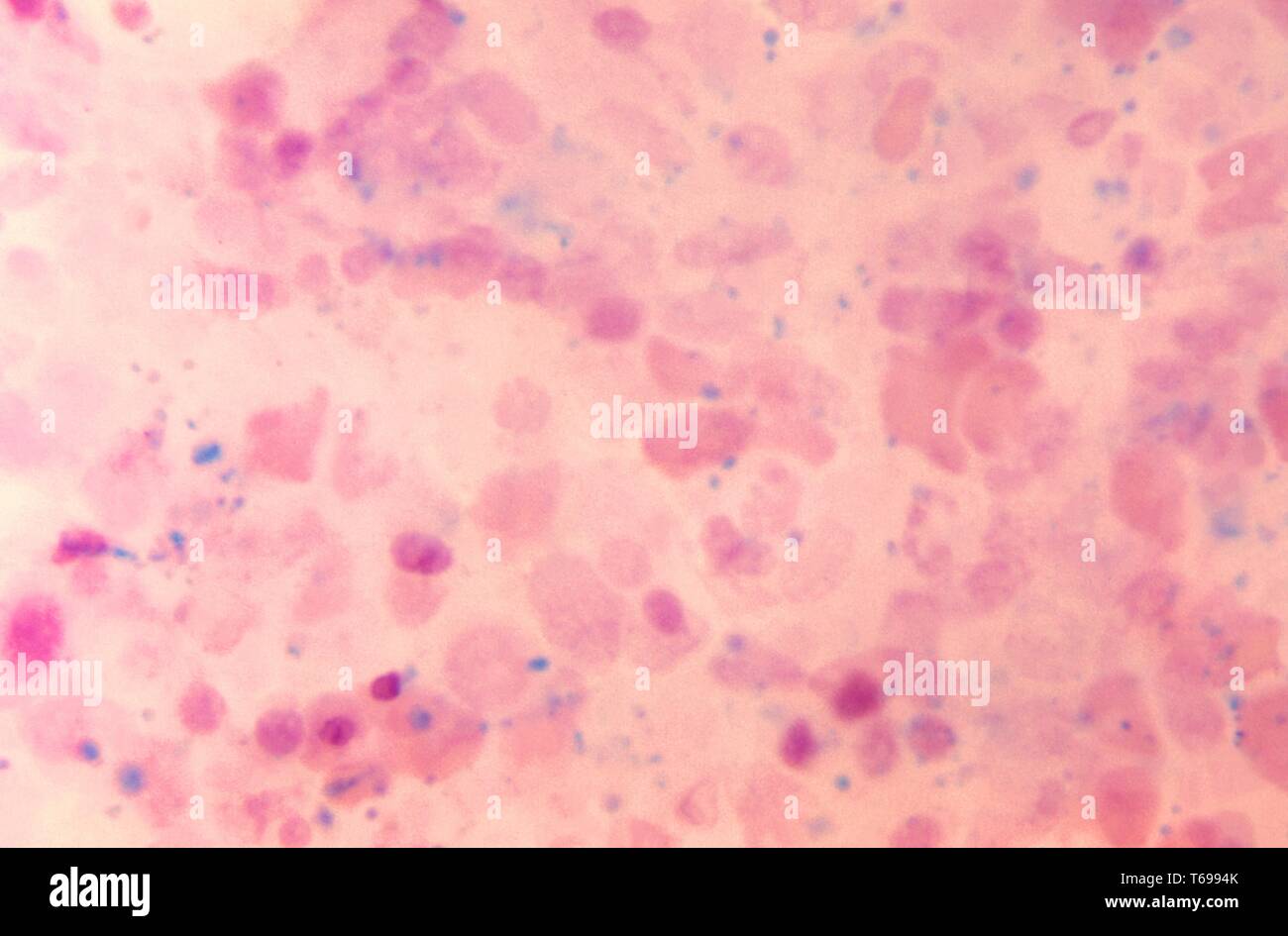 A photomicrograph detecting the presence of hemosiderin, stained blue, within diffuse bone marrow, 1972. Hemosiderin, revealed here using PAS stain and HandE counterstain, is a normal by-product produced during the breakdown of red blood cells, and the decomposition of the hemoglobin molecule contained in these blood components. Image courtesy CDC/Dr. Gordon D. McLaren. Stock Photo