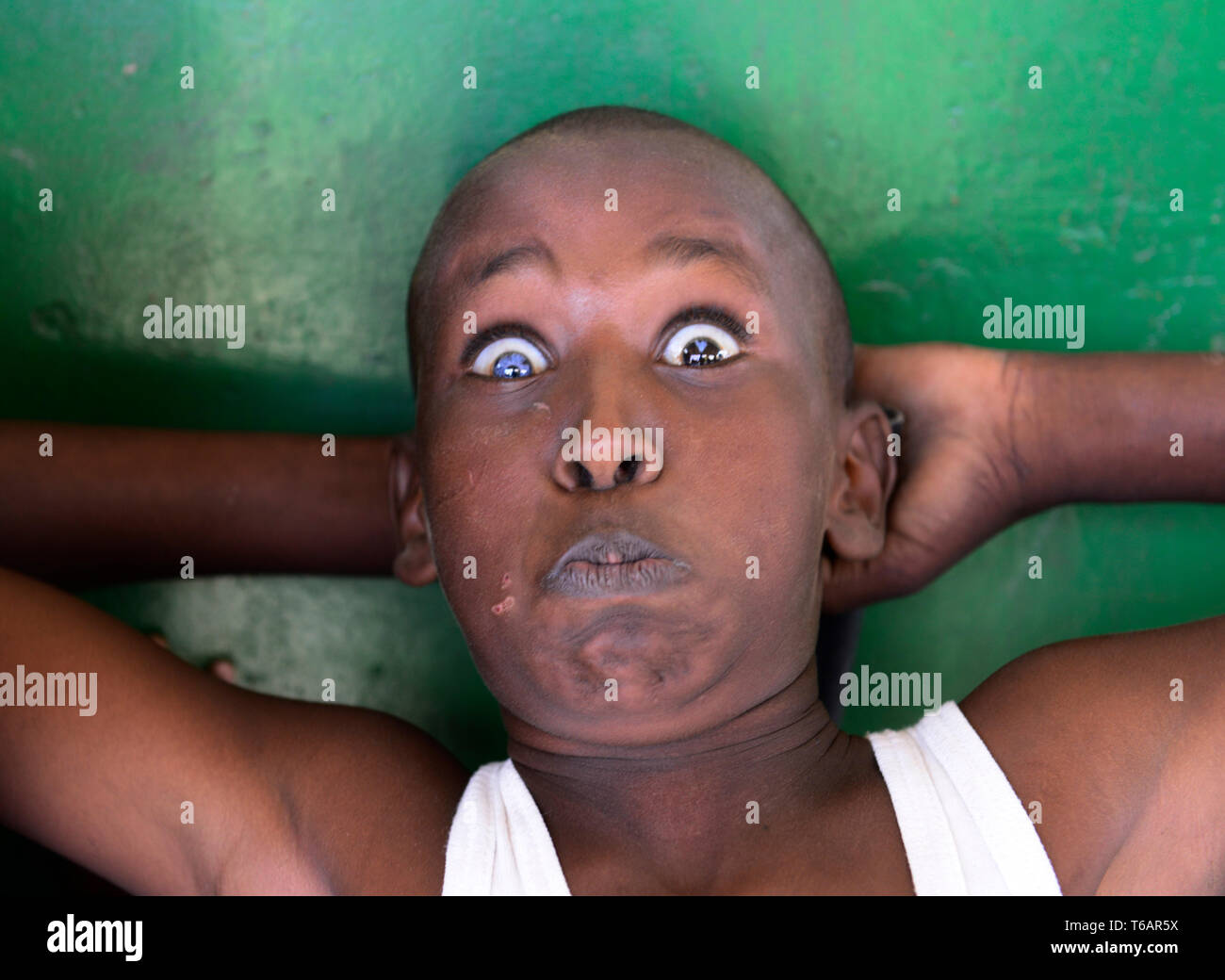 A Kenyan boy that has two different color eyes. this symptom is known as  Heterochromia of the eye. Stock Photo