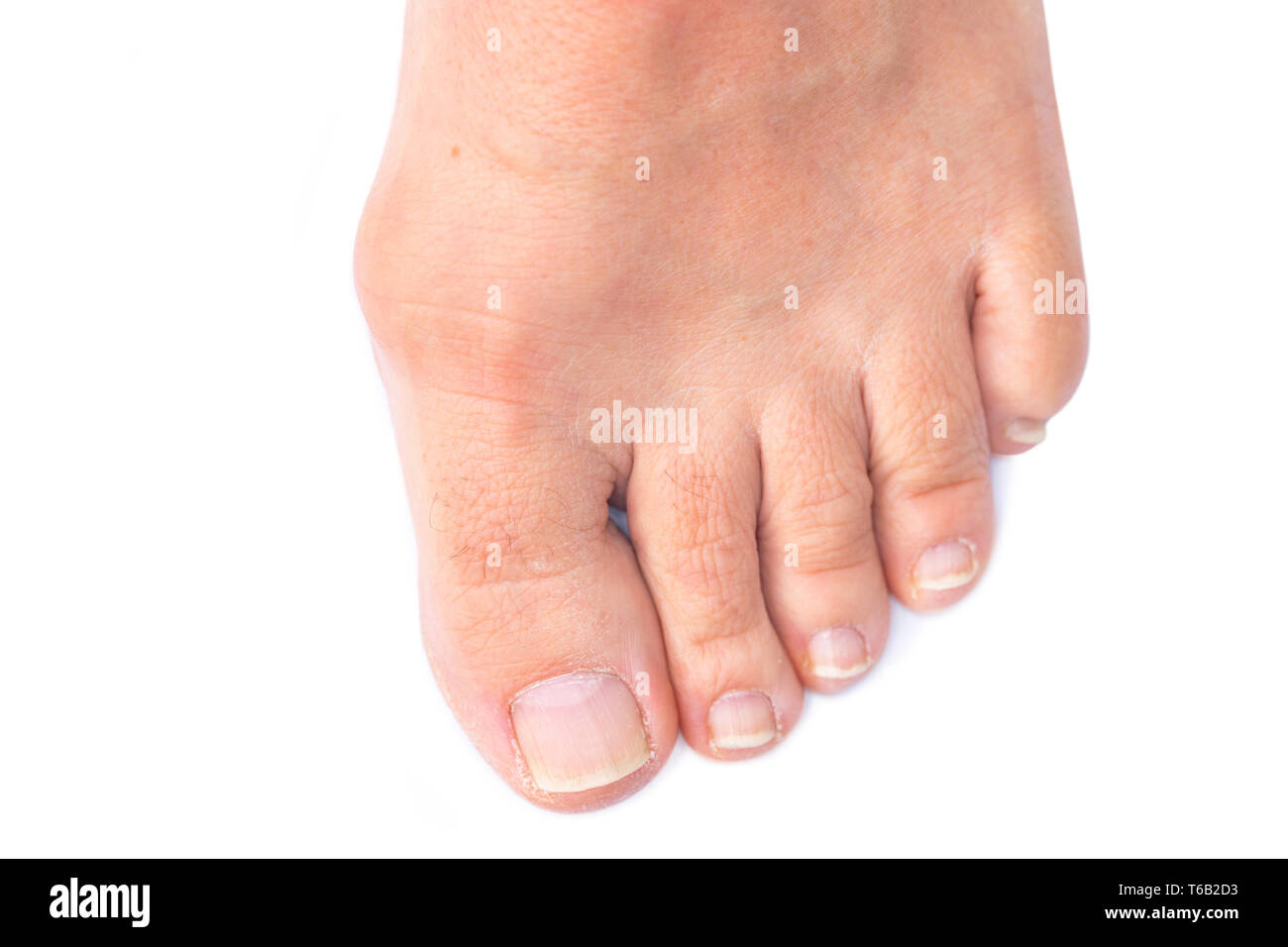 Foot of a woman with painful Hallux Valgus Stock Photo